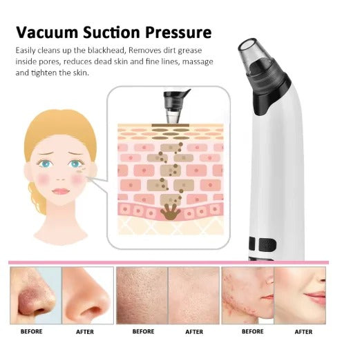 🌟 Blackhead Remover Vacuum – USB Rechargeable Pore Cleaner Kit -  Get deals pk