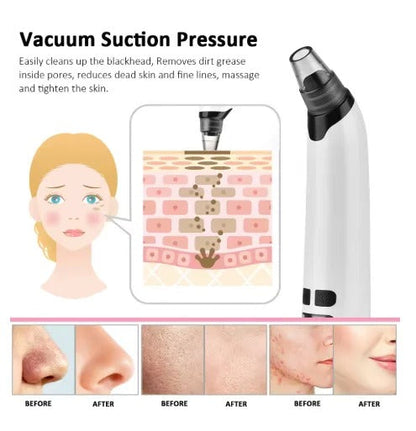 🌟 Blackhead Remover Vacuum – USB Rechargeable Pore Cleaner Kit -  Get deals pk